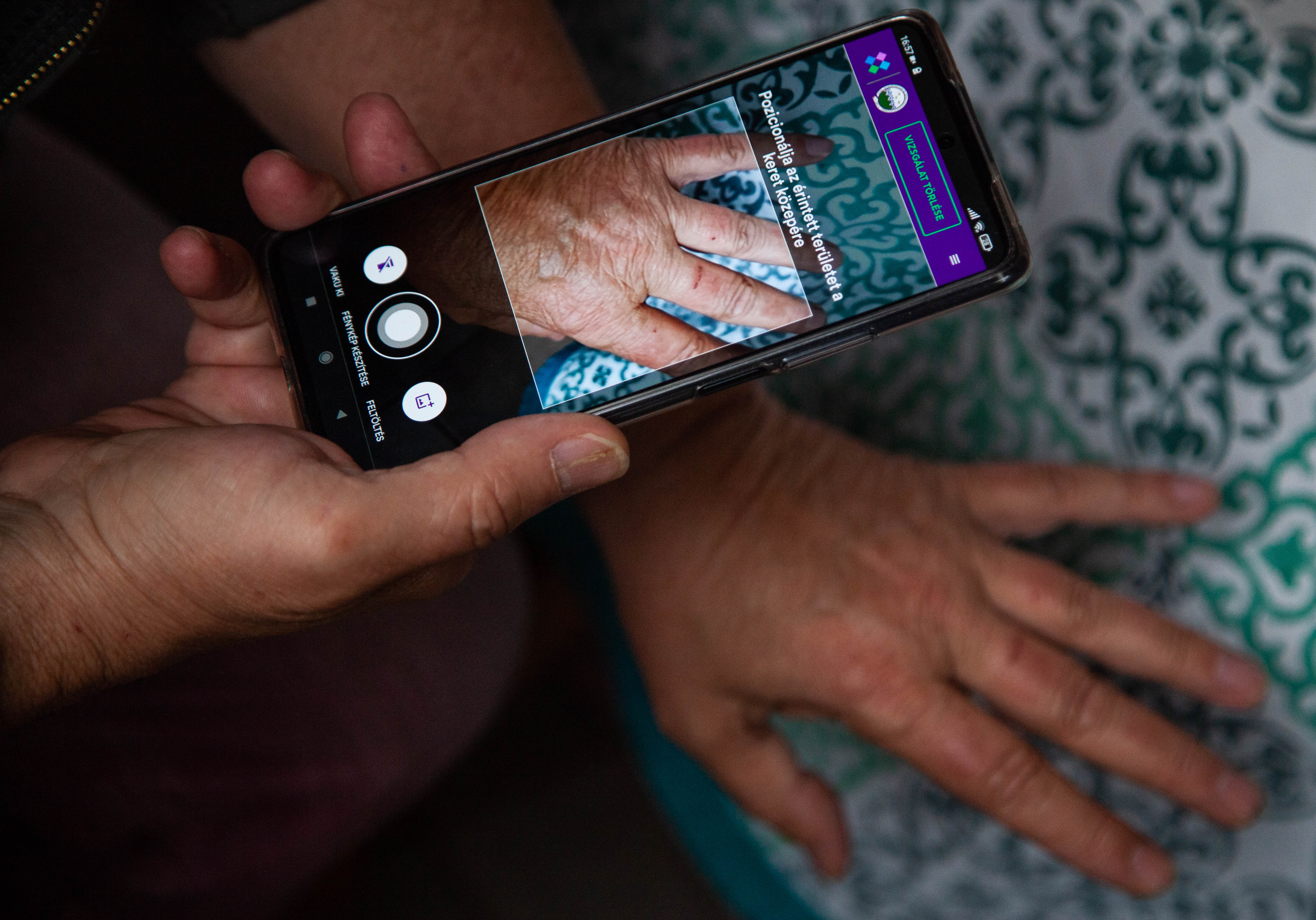 Bőrgyógyászati diagnózis hajléktalan embereknek, mobiltelefonnal készített fotók alapján